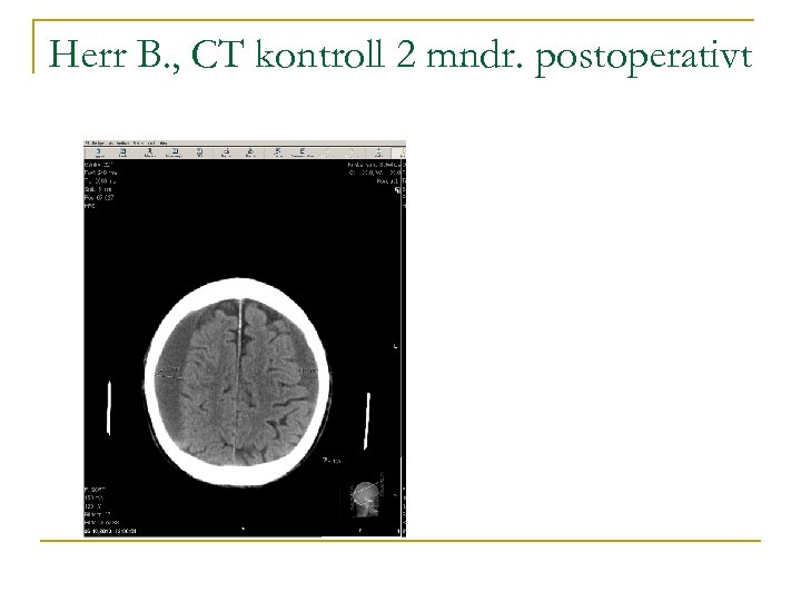 Herr B. , CT kontroll 2 mndr. postoperativt 