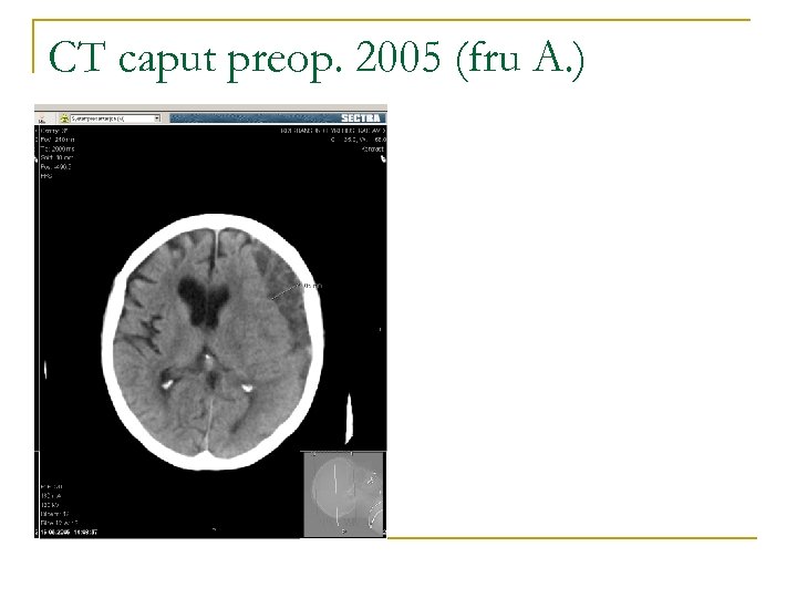 CT caput preop. 2005 (fru A. ) 
