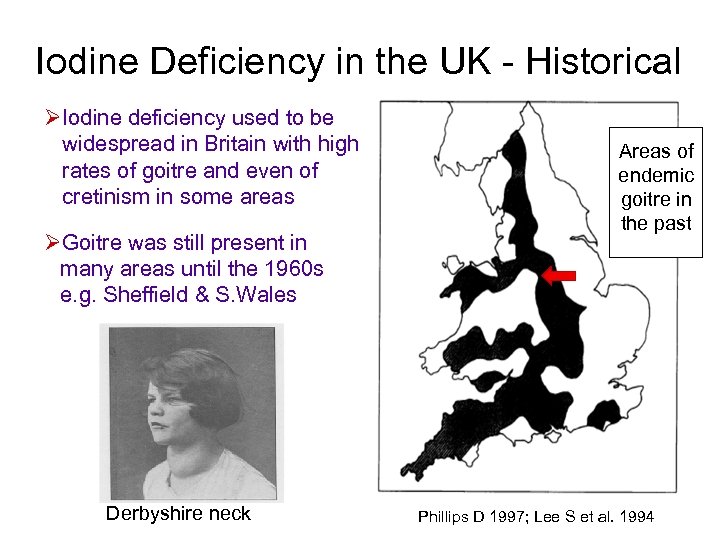 Iodine Deficiency in the UK - Historical ØIodine deficiency used to be widespread in