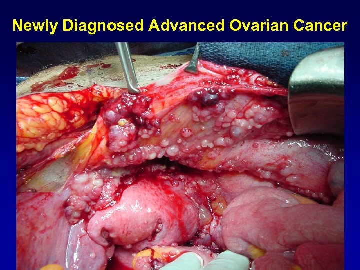 Newly Diagnosed Advanced Ovarian Cancer 