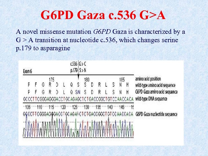 G 6 PD Gaza c. 536 G>A A novel missense mutation G 6 PD