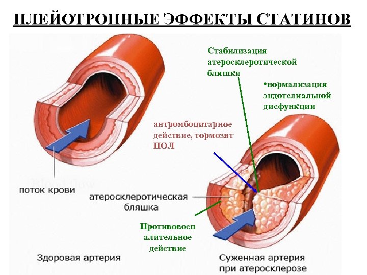 ПЛЕЙОТРОПНЫЕ ЭФФЕКТЫ СТАТИНОВ Стабилизация атеросклеротической бляшки • нормализация эндотелиальной дисфункции антромбоцитарное действие, тормозят ПОЛ