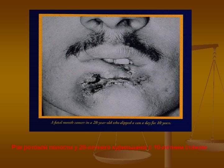 Рак ротовой полости у 28 -летнего курильщика с 10 -летним стажем 