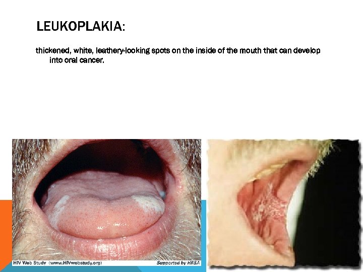 LEUKOPLAKIA: thickened, white, leathery-looking spots on the inside of the mouth that can develop