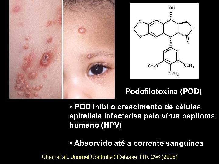 Podofilotoxina (POD) • POD inibi o crescimento de células epiteliais infectadas pelo vírus papiloma