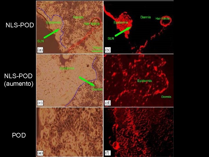 NLS-POD (aumento) POD 