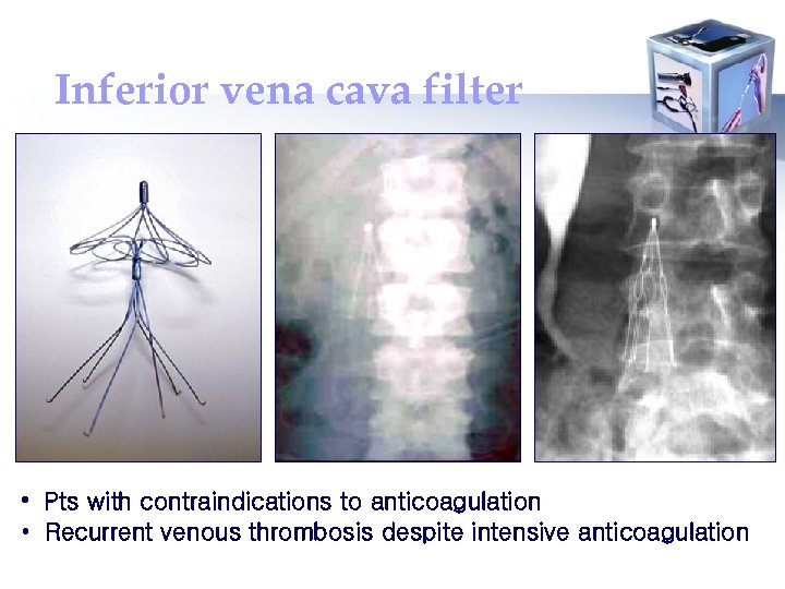 Inferior vena cava filter • Pts with contraindications to anticoagulation • Recurrent venous thrombosis