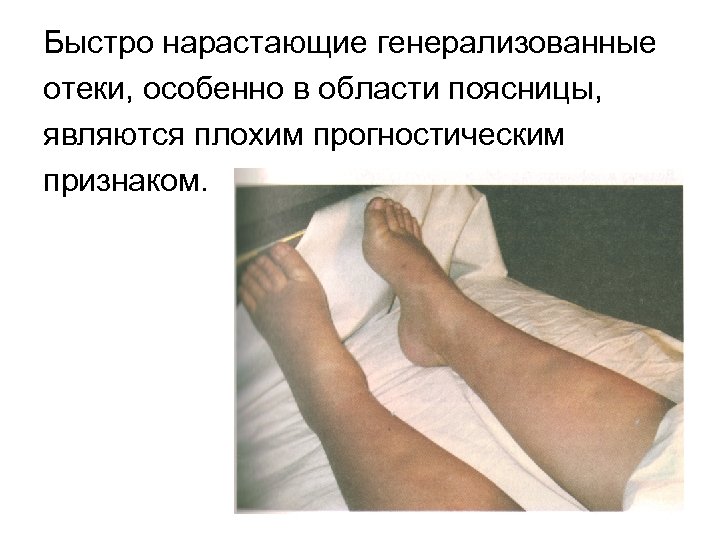 Быстро нарастающие генерализованные отеки, особенно в области поясницы, являются плохим прогностическим признаком. 