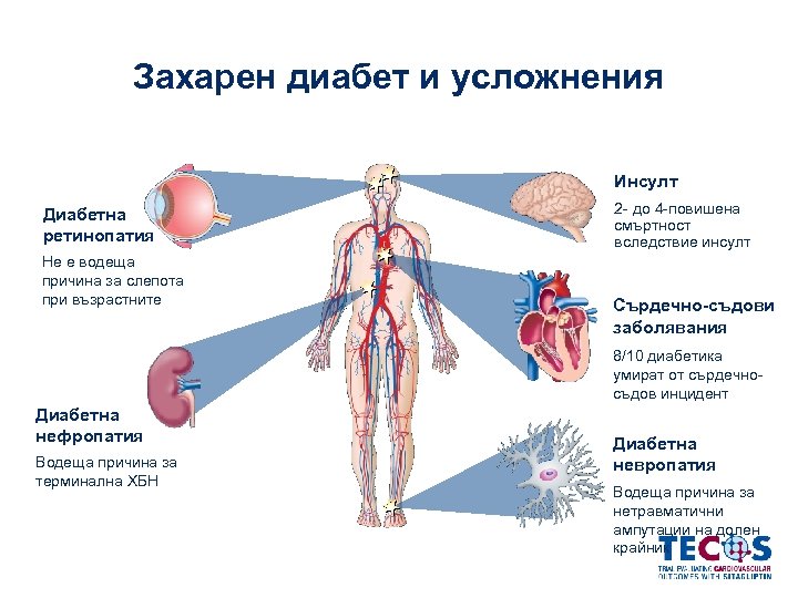 Захарен диабет и усложнения Инсулт Диабетна ретинопатия Не е водеща причина за слепота при