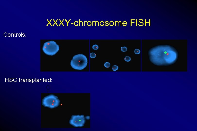 XXXY-chromosome FISH Controls: HSC transplanted: ♀ 