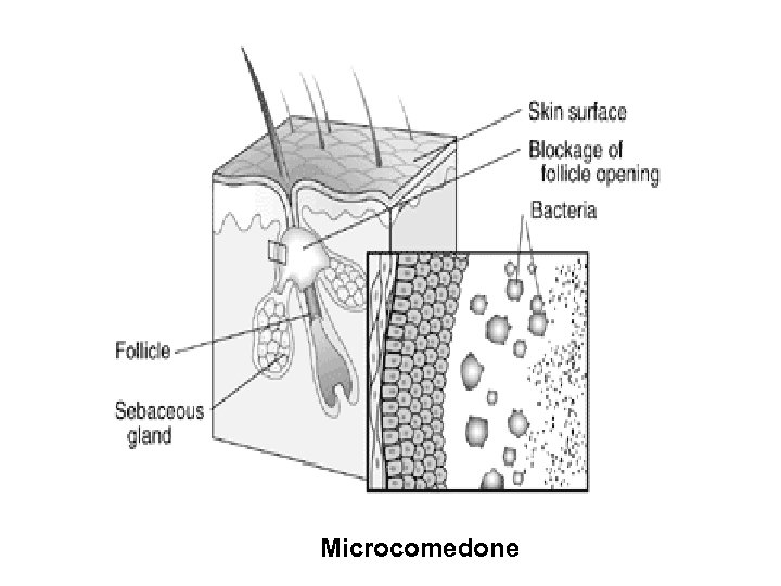 Microcomedone 