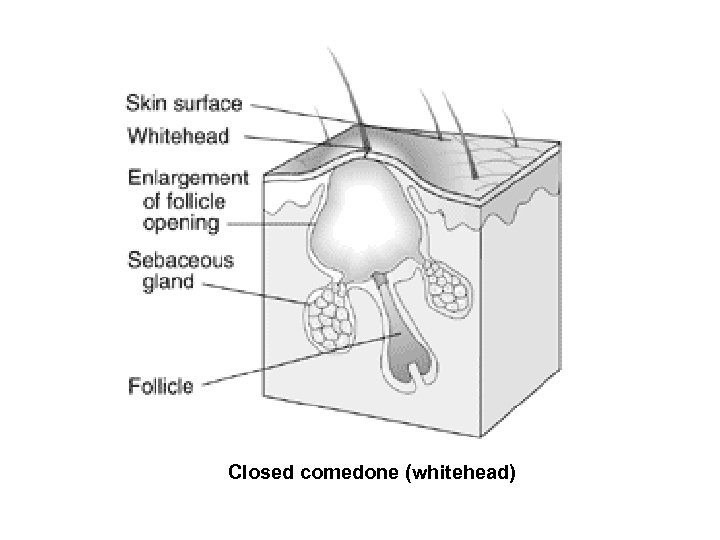 Closed comedone (whitehead) 