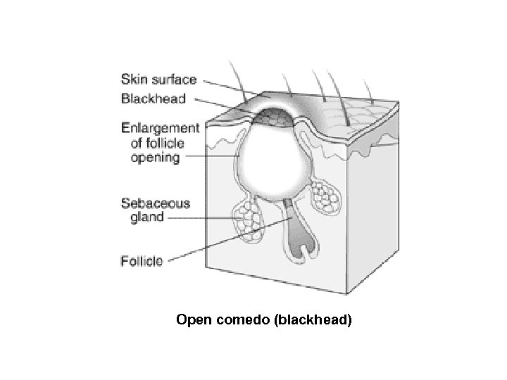 Open comedo (blackhead) 