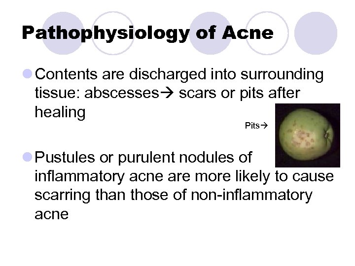 Pathophysiology of Acne l Contents are discharged into surrounding tissue: abscesses scars or pits