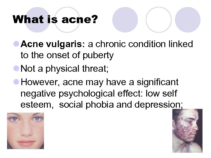 What is acne? l Acne vulgaris: a chronic condition linked to the onset of