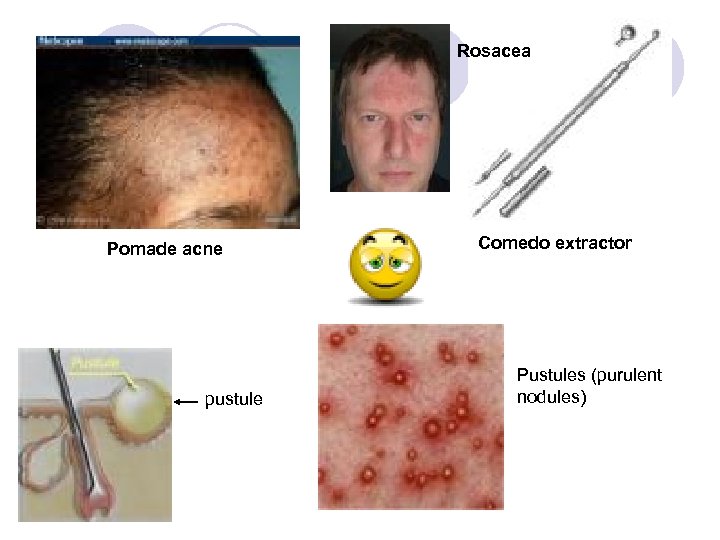 Rosacea Pomade acne pustule Comedo extractor Pustules (purulent nodules) 