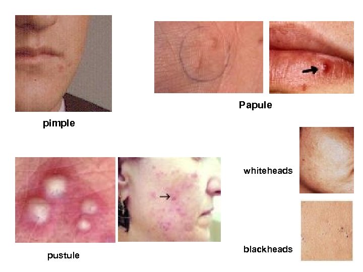 Papule pimple whiteheads pustule blackheads 