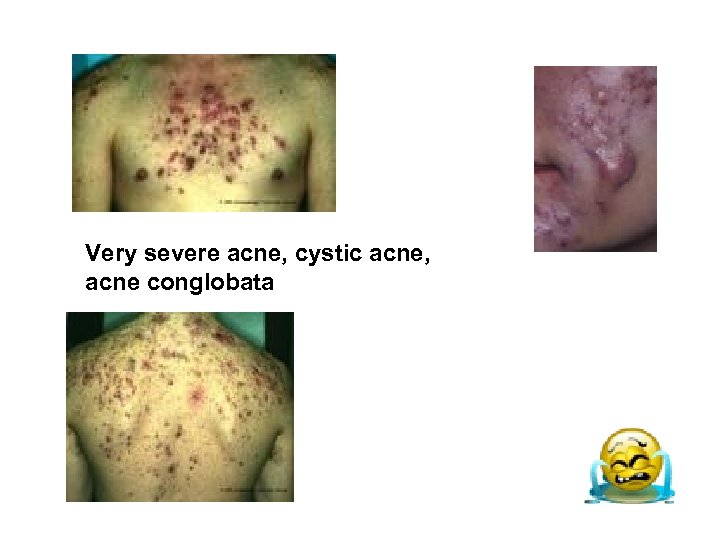 Very severe acne, cystic acne, acne conglobata 