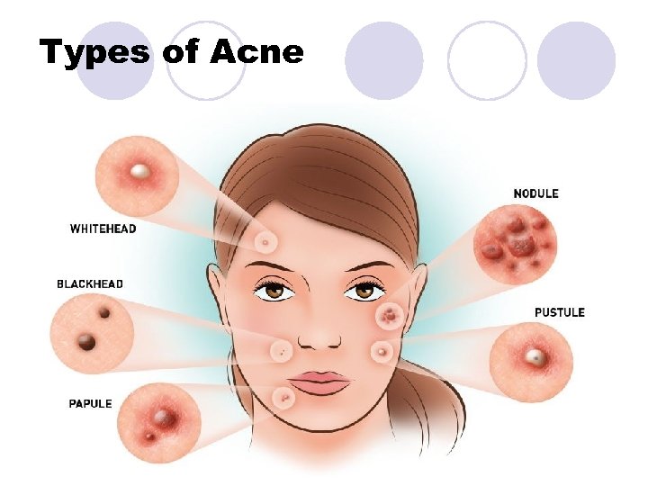 Types of Acne 