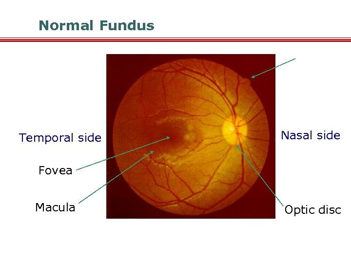 Normal Fundus Temporal side Nasal side Fovea Macula Optic disc 