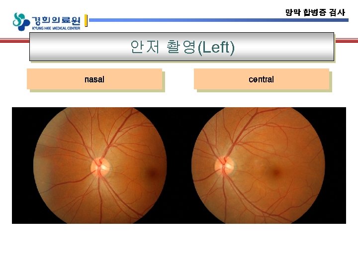망막 합병증 검사 안저 촬영(Left) nasal central 