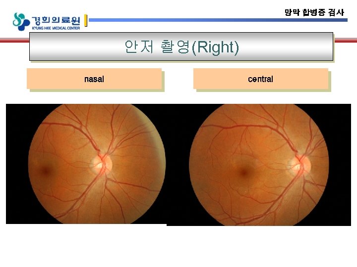 망막 합병증 검사 안저 촬영(Right) nasal central 