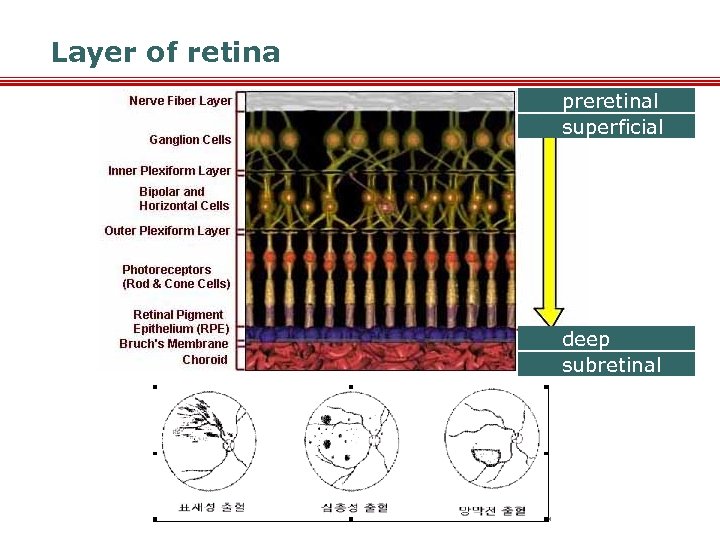 Layer of retina preretinal superficial deep subretinal 