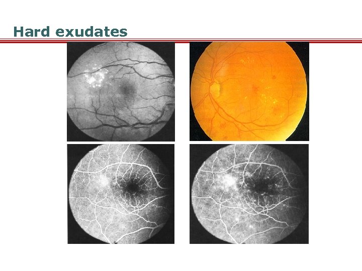 Hard exudates 