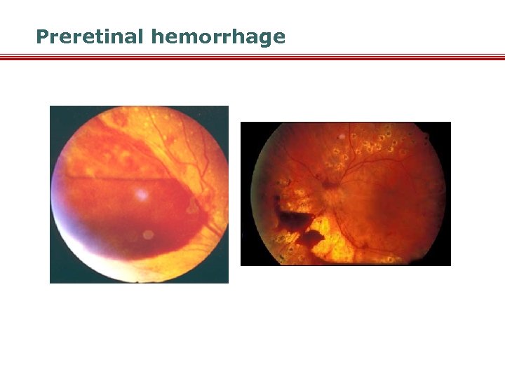 Preretinal hemorrhage 