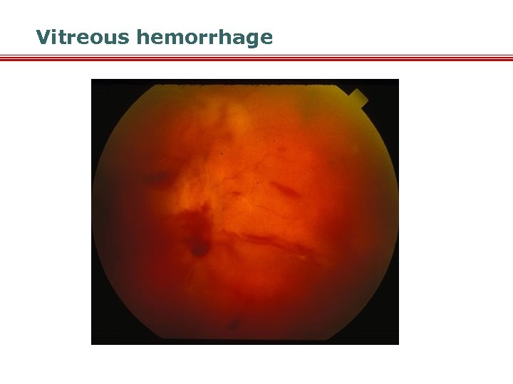 Vitreous hemorrhage 