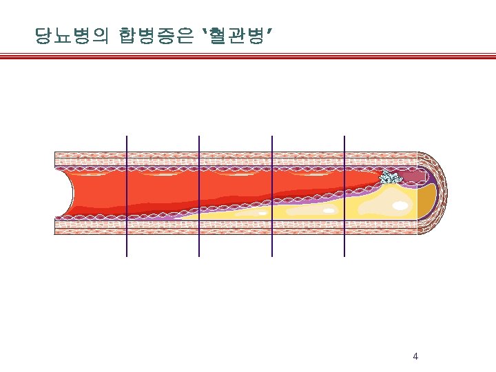 당뇨병의 합병증은 ‘혈관병’ 4 