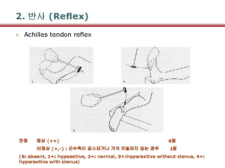 2. 반사 (Reflex) l Achilles tendon reflex 판정 정상 (++) 비정상 (+, -) :
