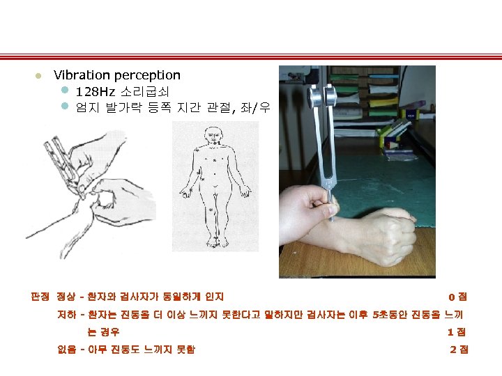 l Vibration perception • 128 Hz 소리굽쇠 • 엄지 발가락 등쪽 지간 관절, 좌/우