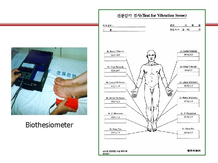 Biothesiometer 