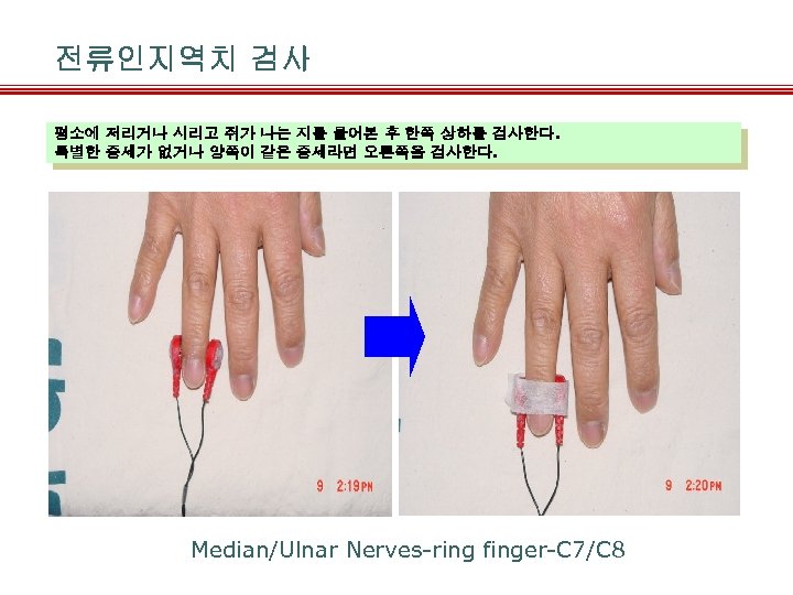 전류인지역치 검사 평소에 저리거나 시리고 쥐가 나는 지를 물어본 후 한쪽 상하를 검사한다. 특별한