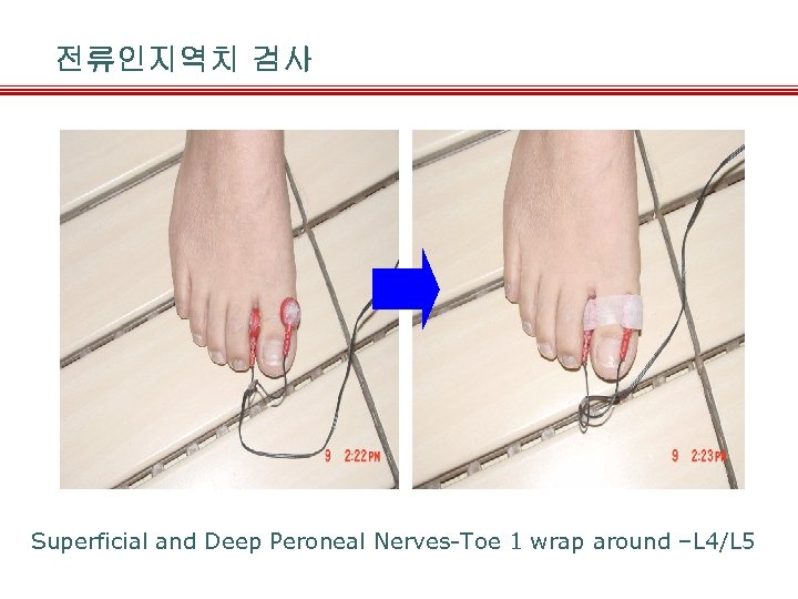 전류인지역치 검사 Superficial and Deep Peroneal Nerves-Toe 1 wrap around –L 4/L 5 