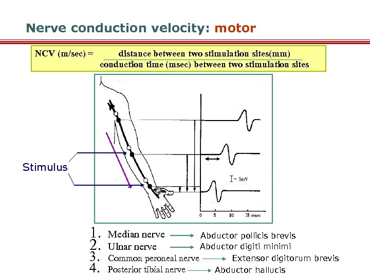 Nerve conduction velocity: motor NCV (m/sec) = distance between two stimulation sites(mm) conduction time
