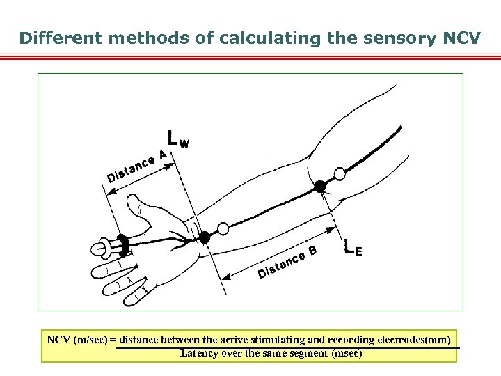 Different methods of calculating the sensory NCV (m/sec) = distance between the active stimulating