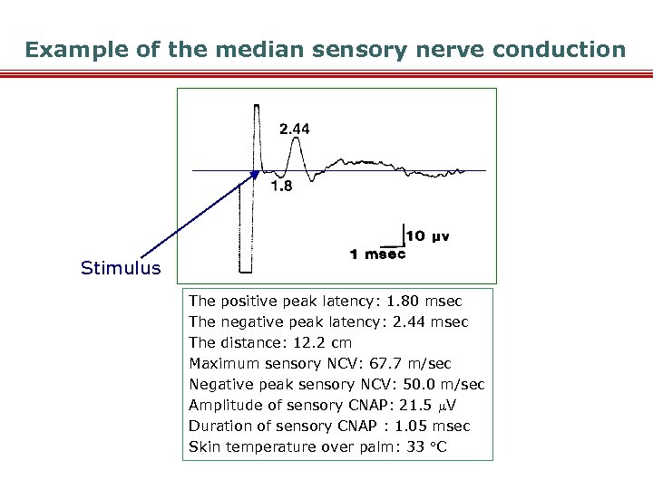 Example of the median sensory nerve conduction Stimulus The positive peak latency: 1. 80
