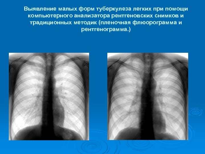 Выявление малых форм туберкулеза легких при помощи компьютерного анализатора рентгеновских снимков и традиционных методик