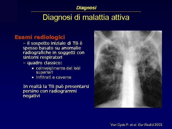 Diagnosi di malattia attiva Esami radiologici – il sospetto iniziale di TB è spesso