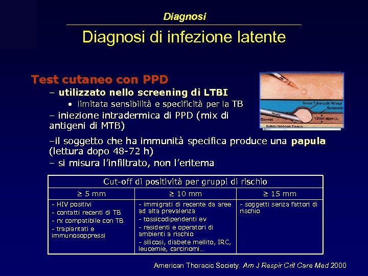 Diagnosi di infezione latente Test cutaneo con PPD – utilizzato nello screening di LTBI