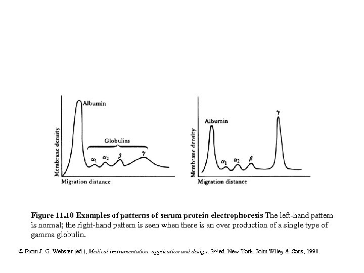 Figure 11. 10 Examples of patterns of serum protein electrophoresis The left-hand pattern is