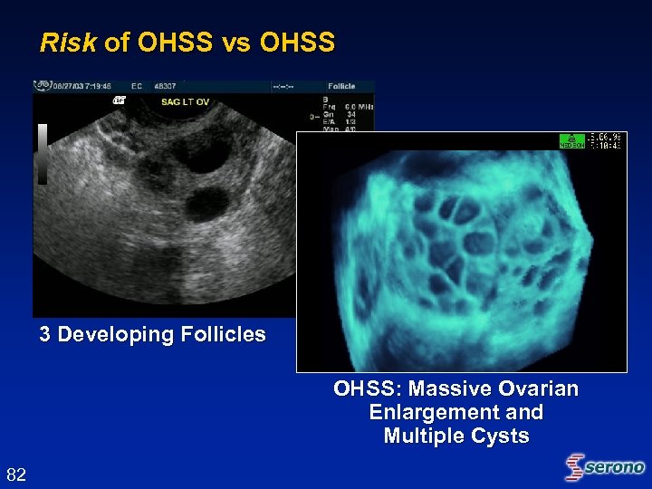 Risk of OHSS vs OHSS 3 Developing Follicles OHSS: Massive Ovarian Enlargement and Multiple