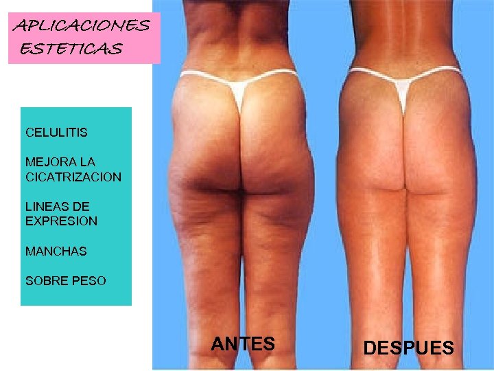 APLICACIONES ESTETICAS CELULITIS MEJORA LA CICATRIZACION LINEAS DE EXPRESION MANCHAS SOBRE PESO ANTES DESPUES