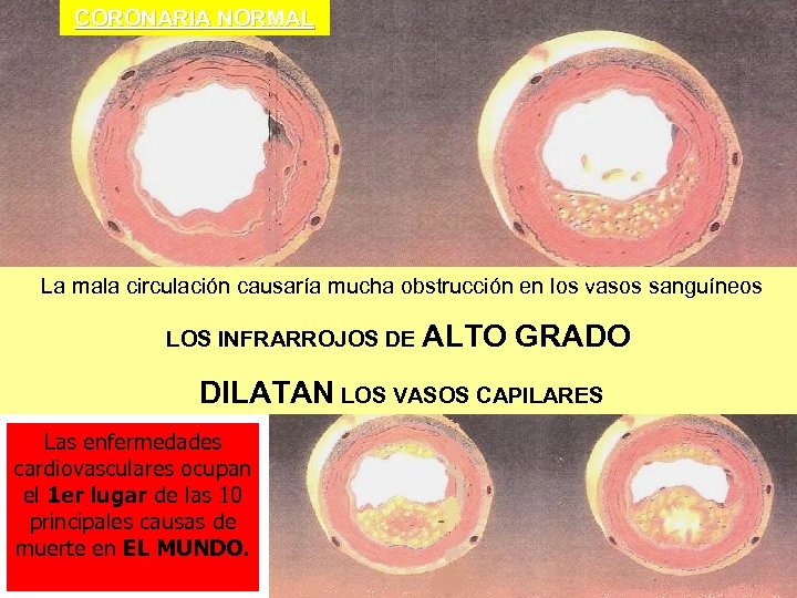 CORONARIA NORMAL La mala circulación causaría mucha obstrucción en los vasos sanguíneos LOS INFRARROJOS