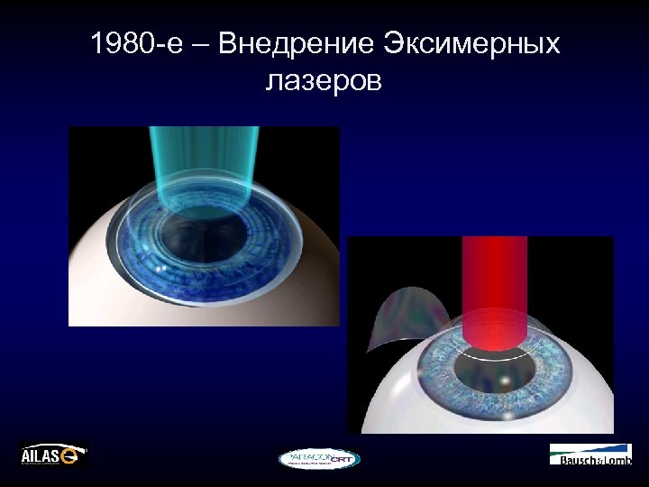 1980 -е – Внедрение Эксимерных лазеров 
