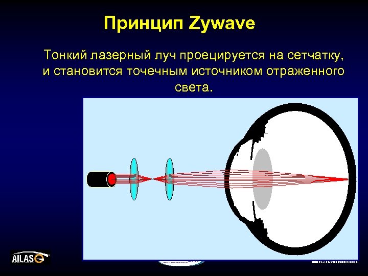 Принцип Zywave Тонкий лазерный луч проецируется на сетчатку, и становится точечным источником отраженного света.