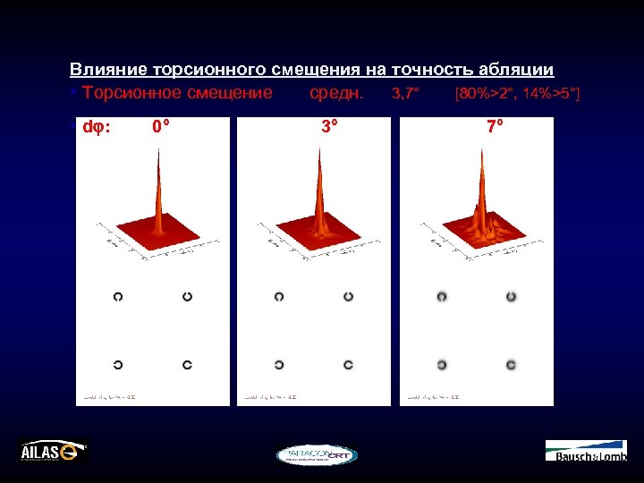 Влияние торсионного смещения на точность абляции • Торсионное смещение средн. 3, 7° [80%>2°, 14%>5°]