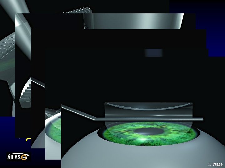 Преимущества • Самые широкие показания: • Миопия – до (-)15. 00 D • Гиперметропия